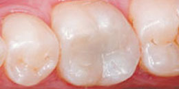 Tooth-colored fillings