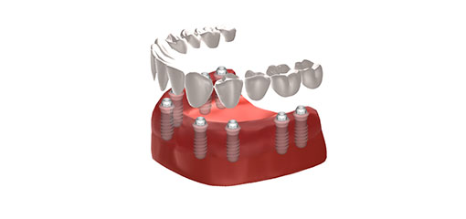 full bridge implants