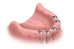 tooth implant bridges