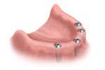 dentures implant