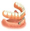 implant support dentures