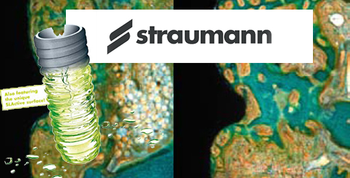 dental implants straumann