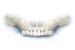 zygomatic implant