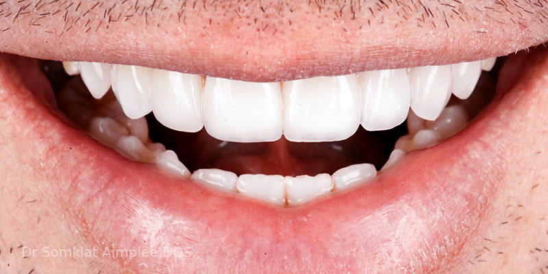 bangkok tooth bridge