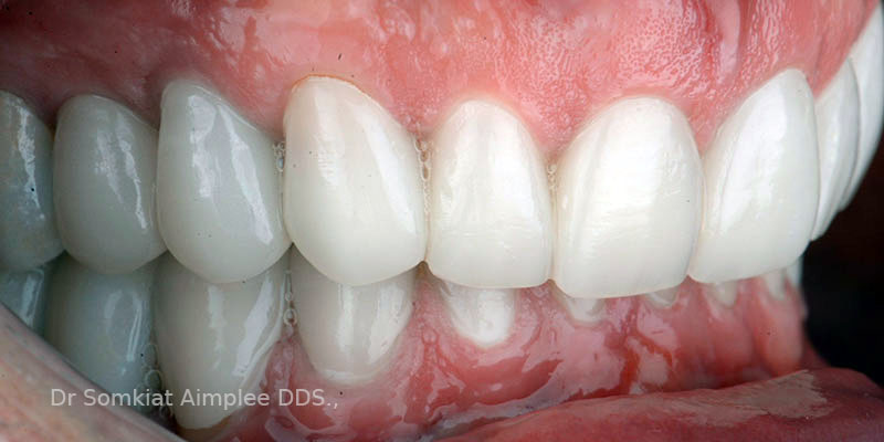 bangkok dental bridge