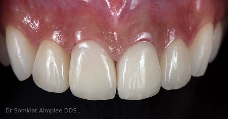 after dental crowns