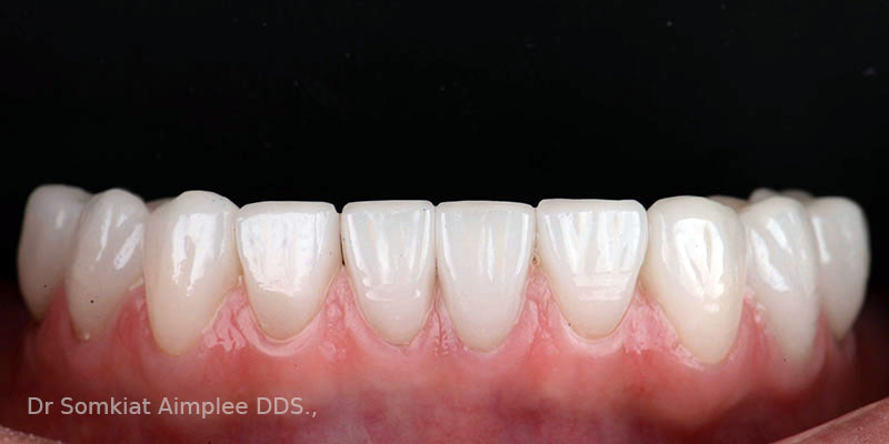 after teeth crowns