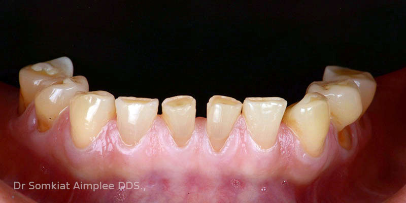 before teeth crowns