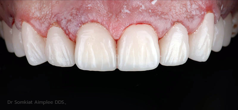 after tooth crowns