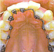 bangkok hidden braces