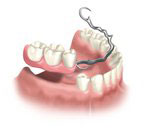bangkok partial dentures